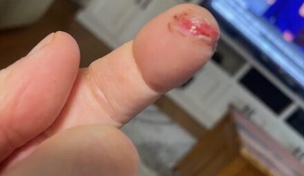 Harv Weiler Finger Save